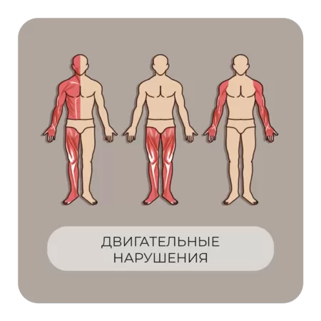 Двигательные нарушения